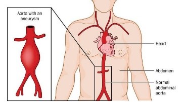 Ilustrasi aorta dengan aneurisma dan aorta normal